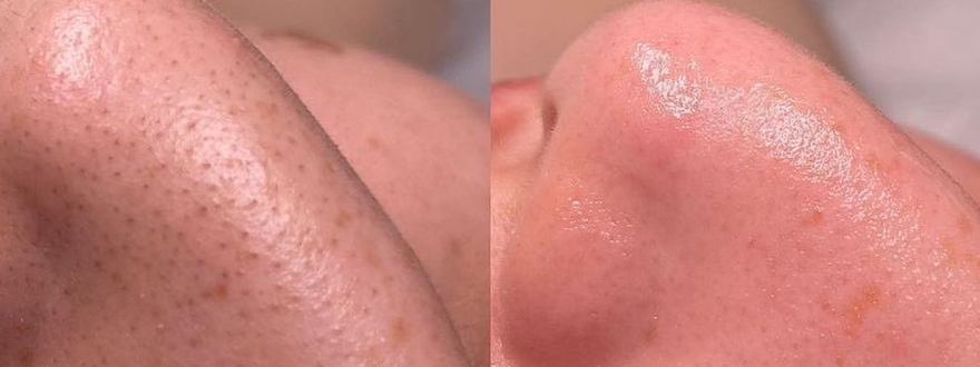 Hydrafacial – Purify